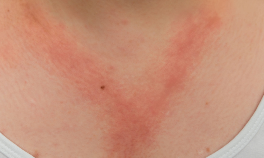 SIH Contact dermatitis